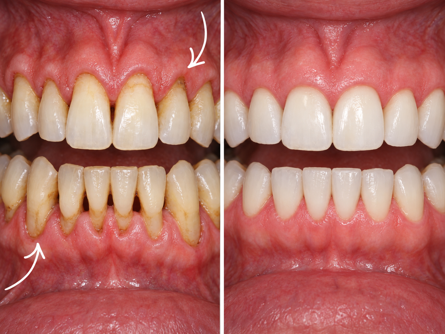 Before and after: gum recession reversed with GumVive CollaGum